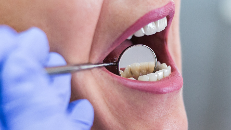 Un dentista revisa a una mujer si tiene caries.
