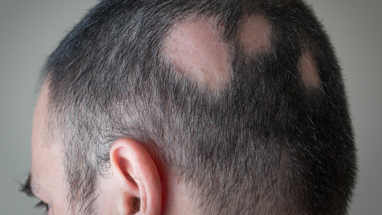 Qué Es La Alopecia Areata: Causas, Síntomas Y Tratamientos