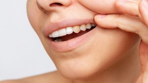 Cropped shot of a young woman showing shows yellow fangs. Dark tooth enamel, contrast